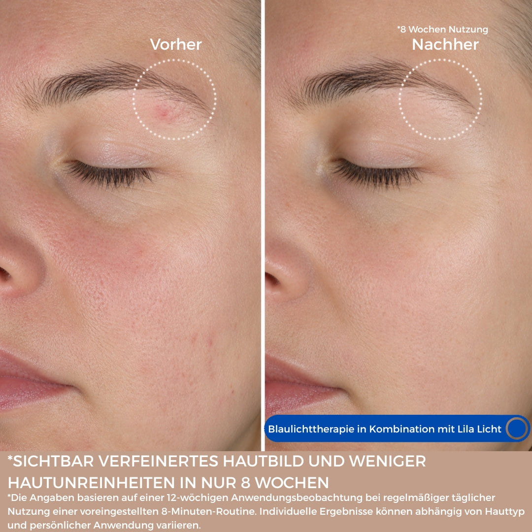 SkinLift™ Pro Set
