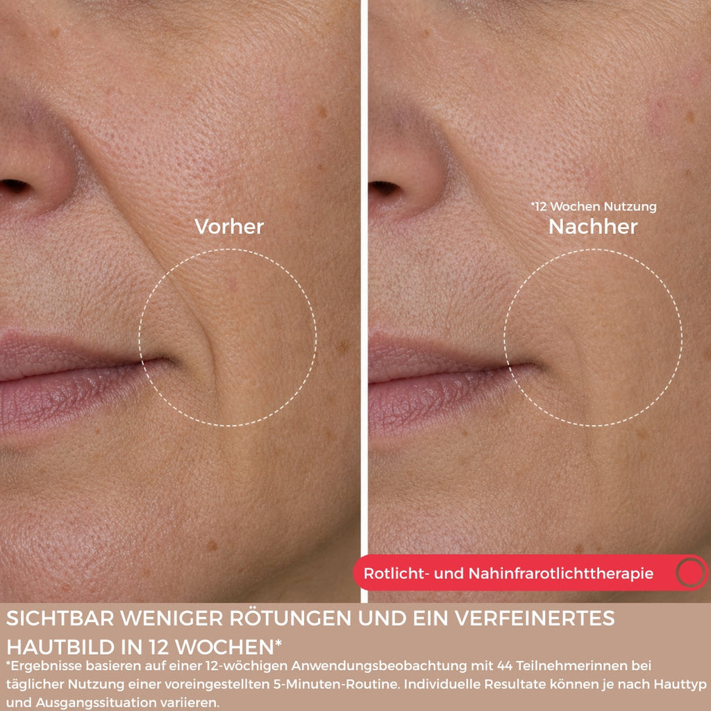 SkinLift™ Pro Set