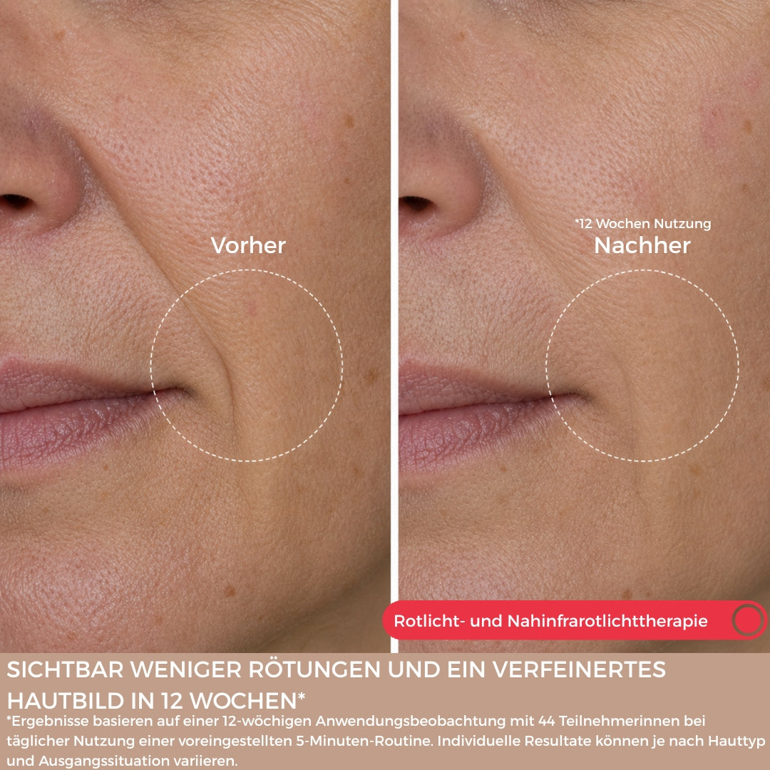 SkinLift™ Pro Set